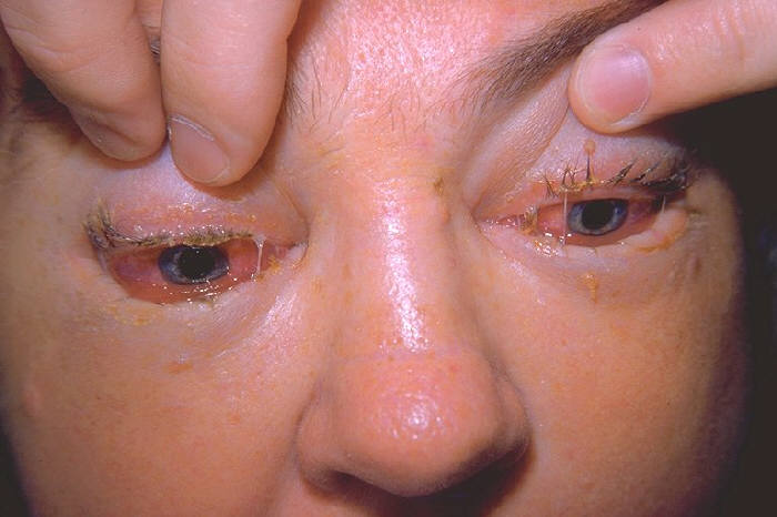 trichinellapacient